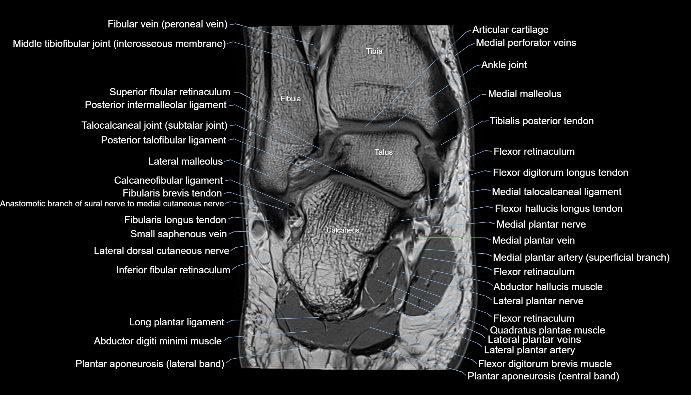 Ankle coronal anatomy 3T MRI images -img-11001-00016.webp
